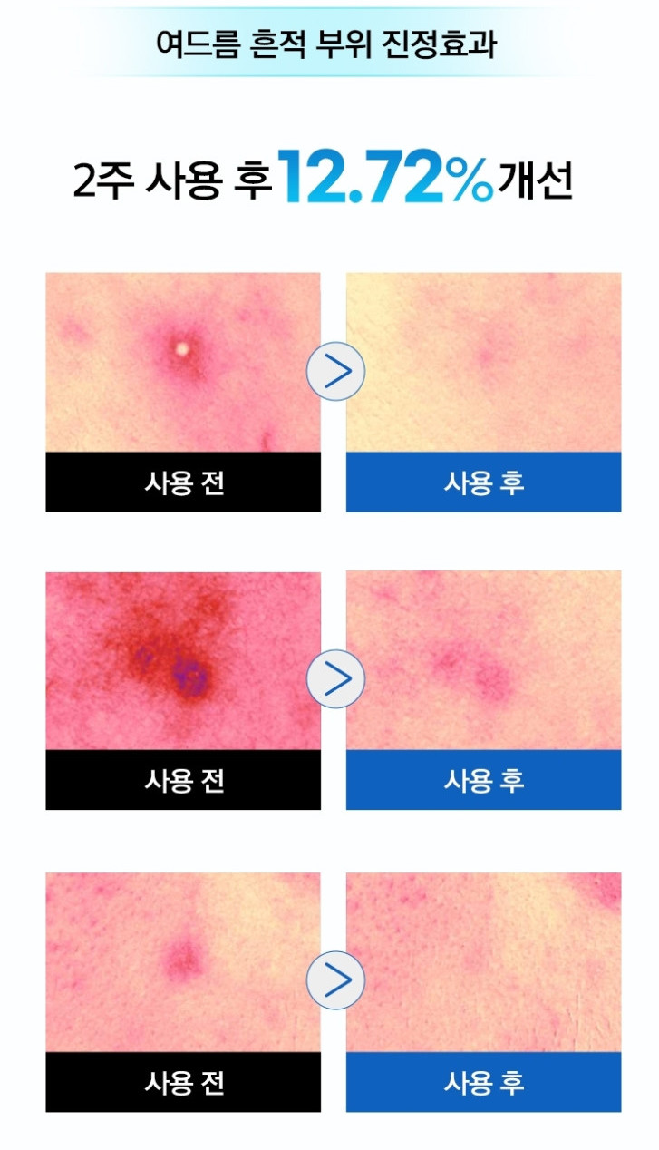 여드름 흔적 부위 진정효과 — 2주 사용 후 12.72% 개선